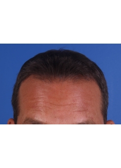 After Hair Transplant&nbsp;2 Sessions (Areas)